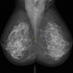 mammogram